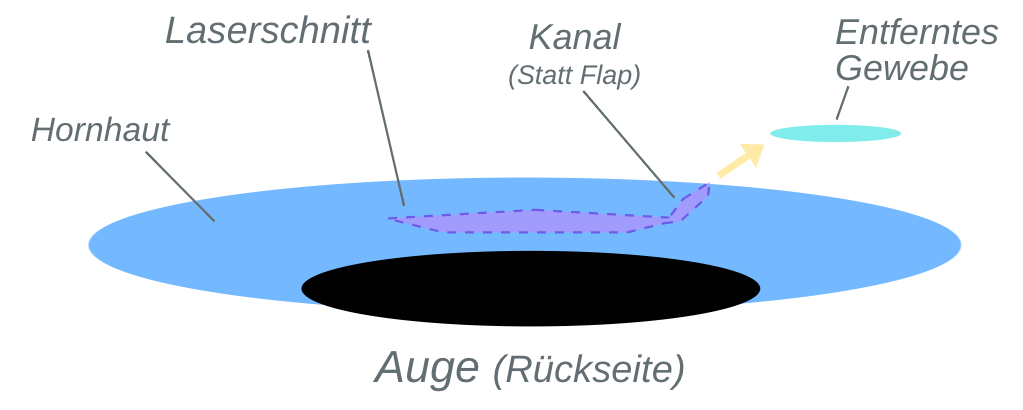 Relex Smile - Verfahren