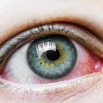 Brennende Augen Allergie