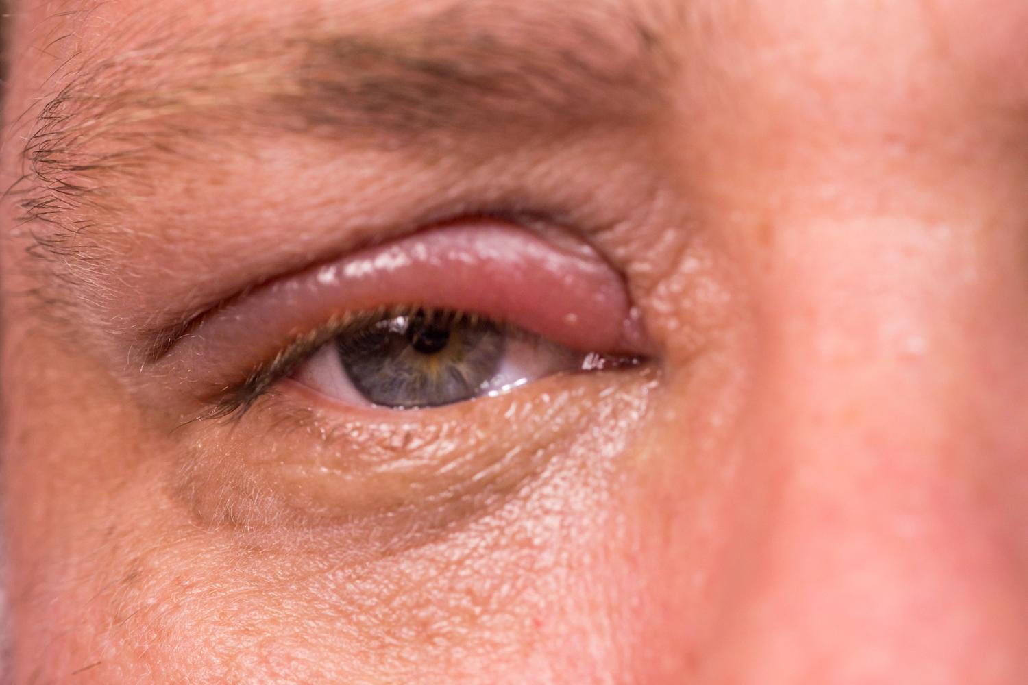 angeschwollene-augen-was-tun